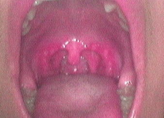 舌 赤い ぶつぶつ